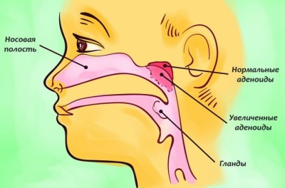 Аденоиды у детей лечение препараты схемы