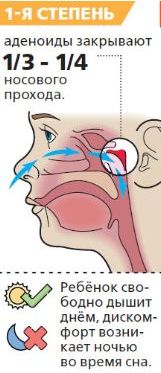 Лазер при аденоидах у детей схема